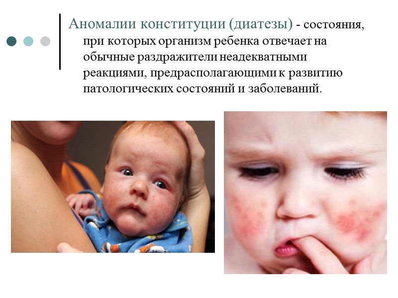 Аномалии конституции (диатезы) - состояния, при которых организм ребенка отвечает на обычные раздражители неадекватными